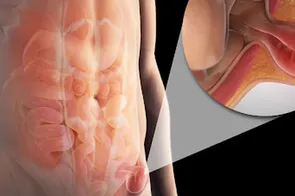 Hernia inghinală