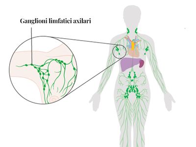 Ganglion santinelă