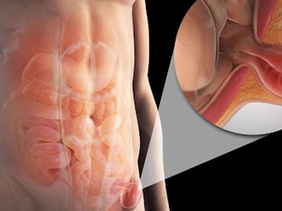 Hernia inghinală
