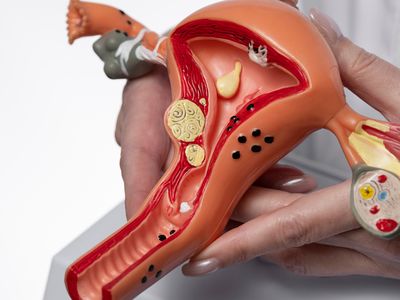 Polip endometrial – polip uterin