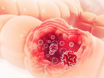 Semne și simptome ale cancerului de colon la bărbați