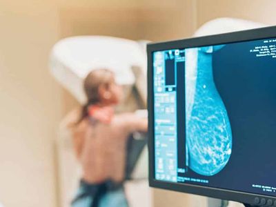 Scorul BIRADS: Riscul de a dezvolta cancer mamar