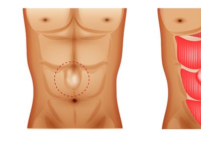 Hernia ombilicală
