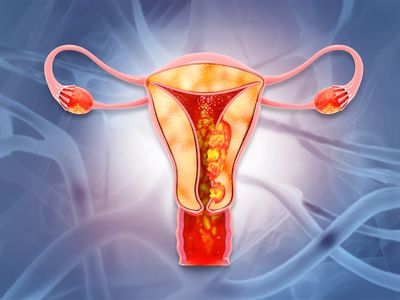 Cancer de col uterin