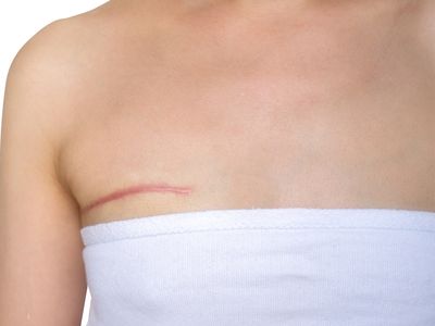 Reconstrucția sânului după cancer mamar