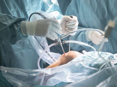 Ligamentoplastia