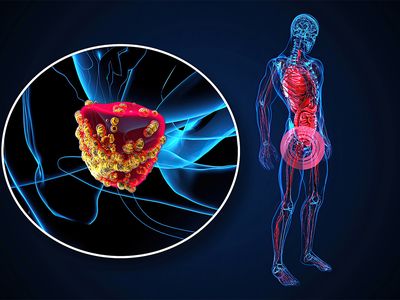 Cancer de prostată