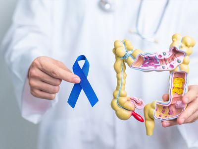 Cancerul colorectal