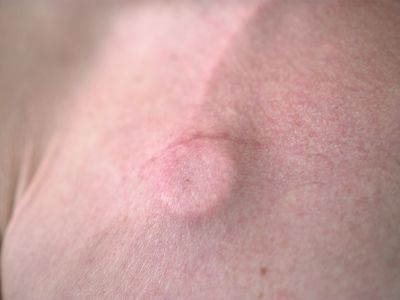 Camere implantabile chimioterapie