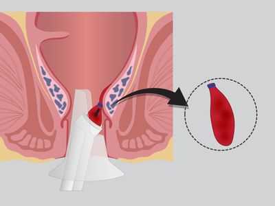 Ligatura hemoroizilor cu benzi elastice