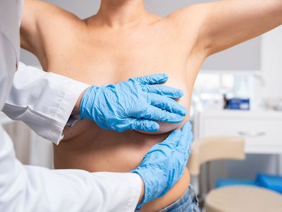 Cancerul mamar HER2 - pozitiv