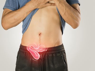 Explicații despre hernii pe înțelesul tuturor