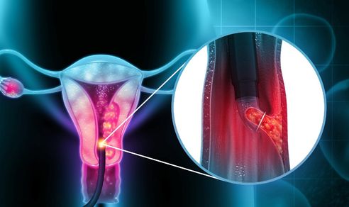 Biopsie endometrială
