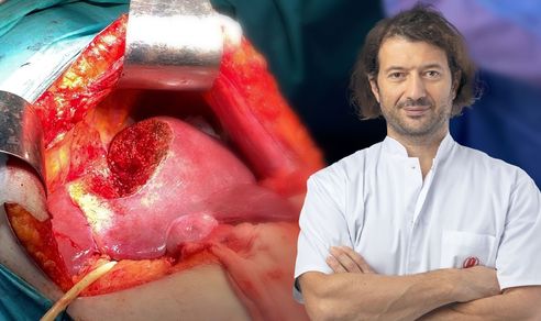 Metastază cancer de colon: rezecție atipică segment 8 hepatic