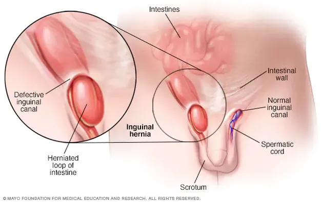 Hernia inghinală