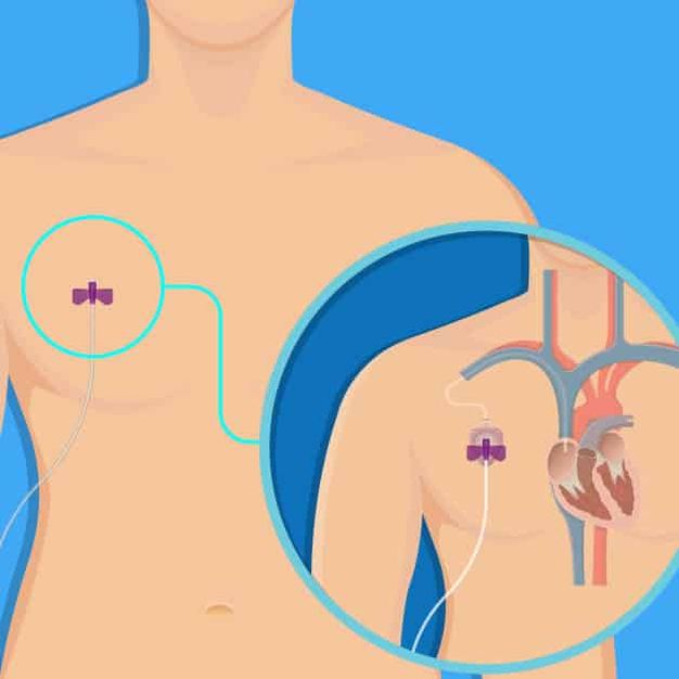 Camere implantabile chimioterapie