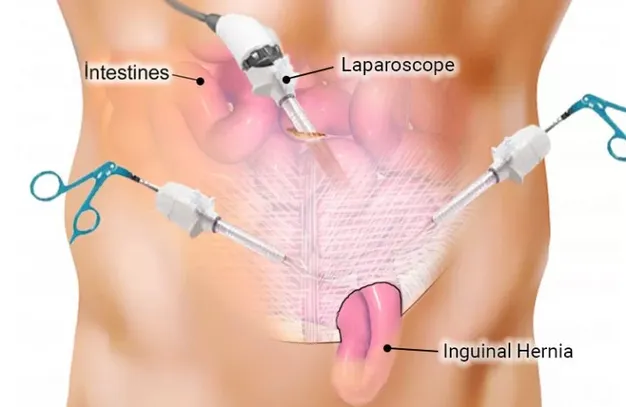 Hernia inghinală