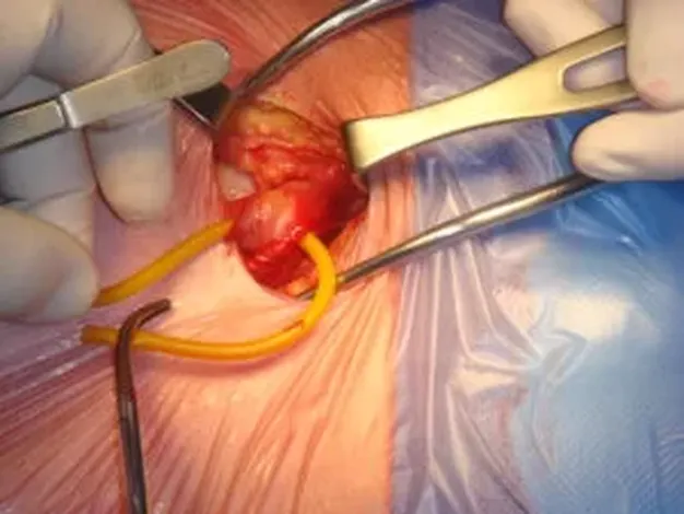 Hernia inghinală