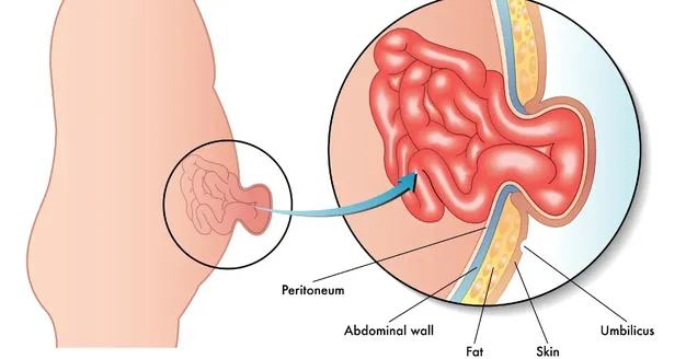 Hernia ombilicală