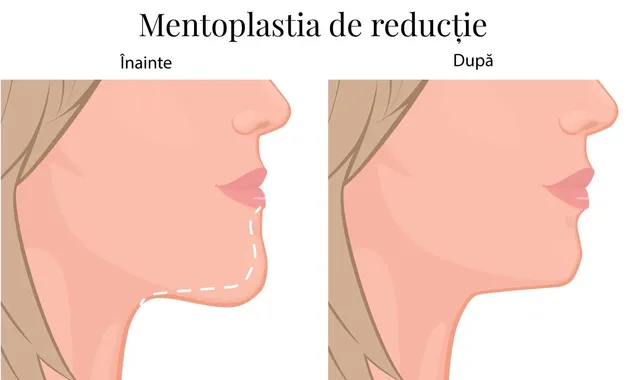 Mentoplastia de reducție – remodelarea bărbiei