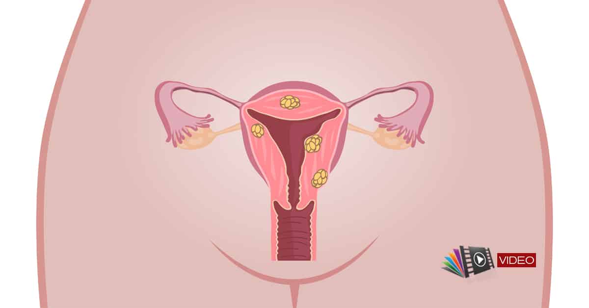 Ce este fibromul uterin și cum apare