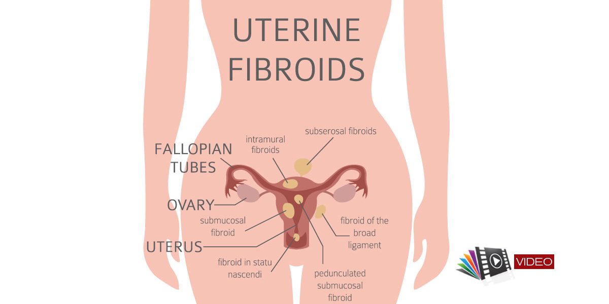 pierdere în greutate fibroame uterine