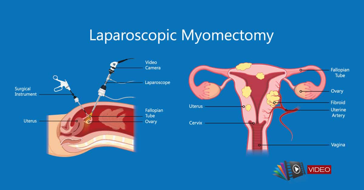Tratamentul chirurgical al fibromului uterin prin miomectomie