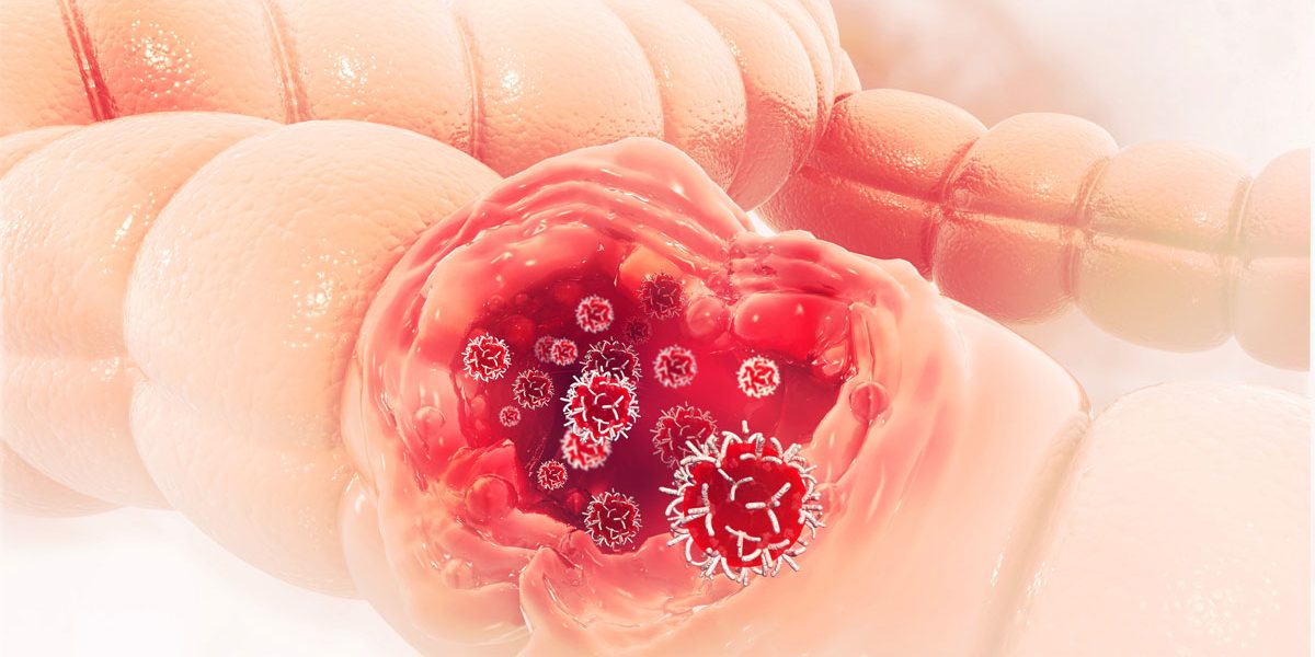 simptome cancer de colon la femei