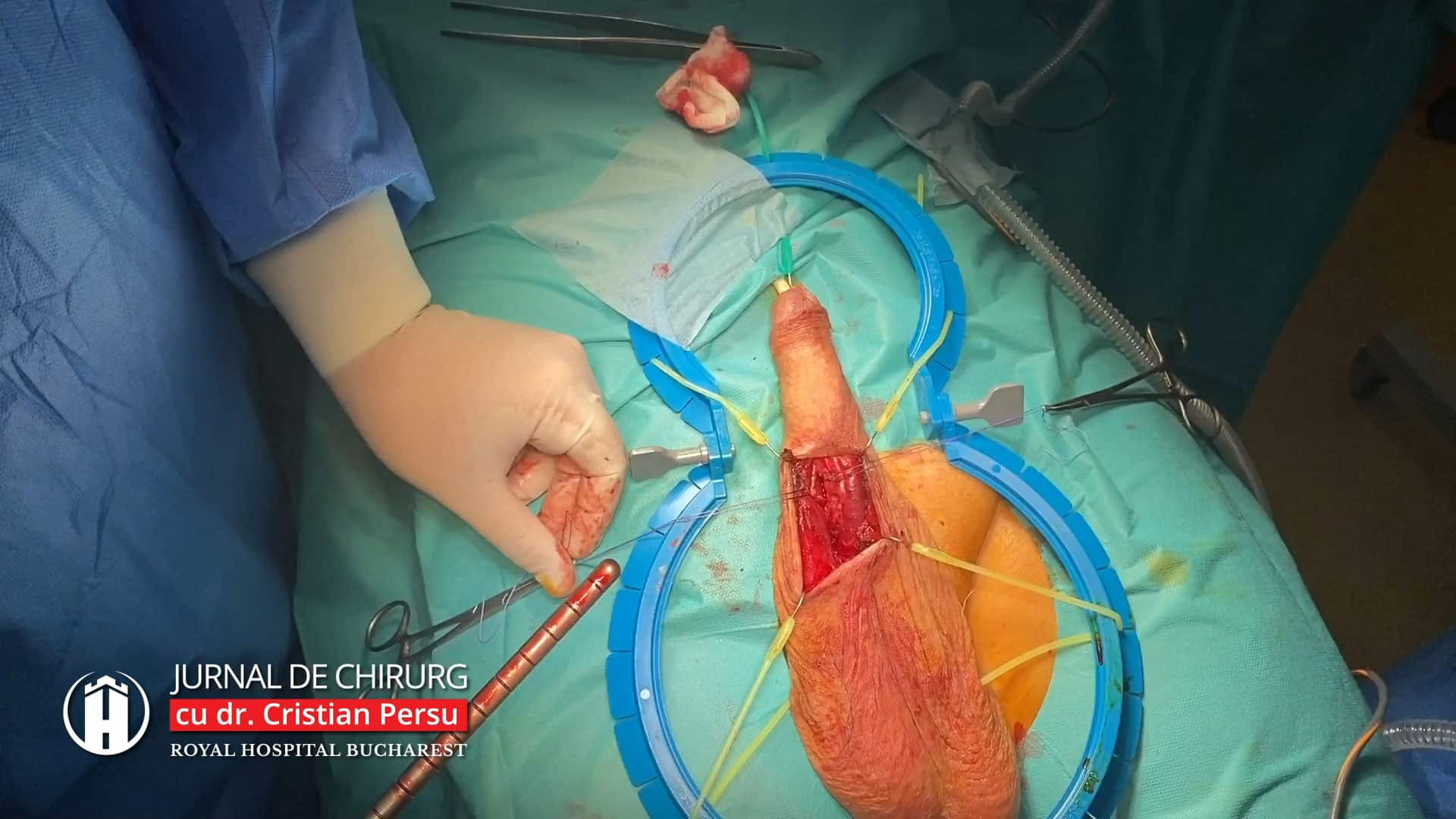 implant de erecție curbura congenitală a penisului