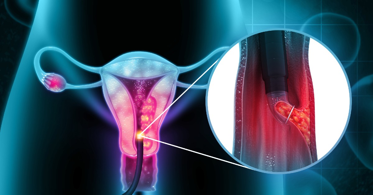 Biopsie endometrială – identificarea cauzei de sângerare anormală