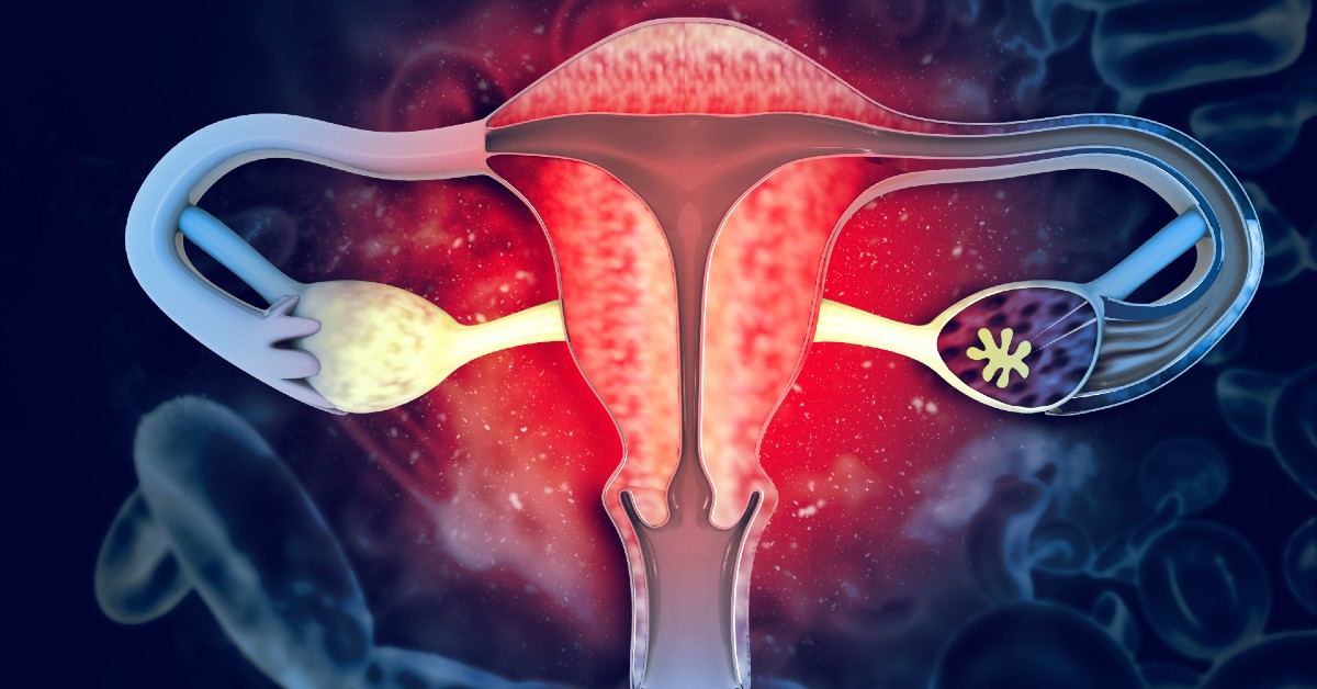 Ce este un uter fibromatos?